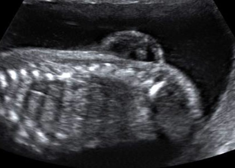 Sociodemographic characteristics associated with spina bifida outcomes