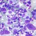 PET scans in early-stage Hodgkin’s lymphoma may help guide therapy [RAPID trial]