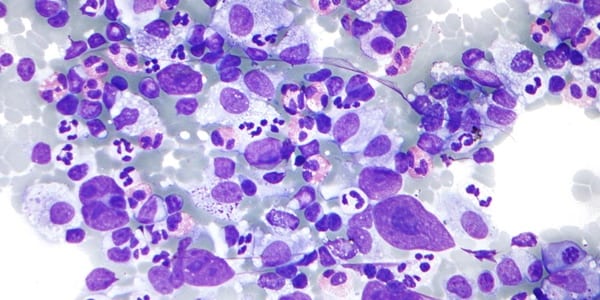 CC/Wiki/Nephron Hodgkin_lymphoma_cytology_large