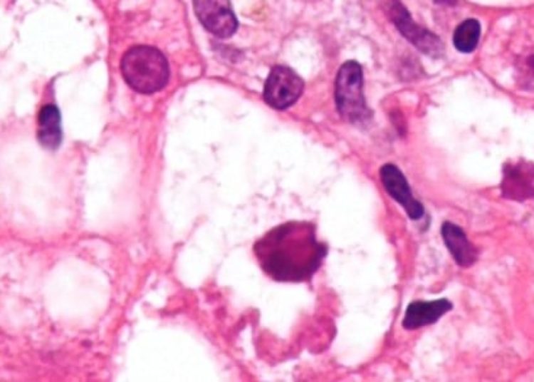 Prednisolone and pentoxifylline do not reduce mortality in alcoholic hepatitis [STOPAH trial]