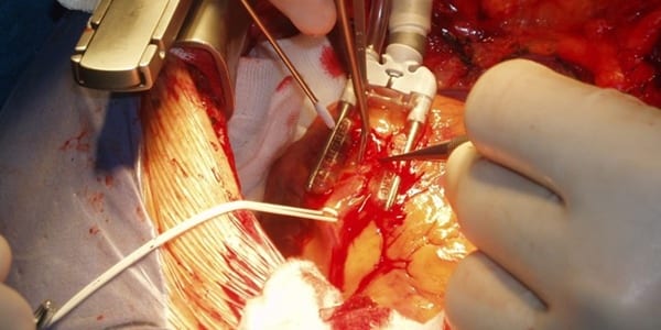 Wiki/CC heart surgery