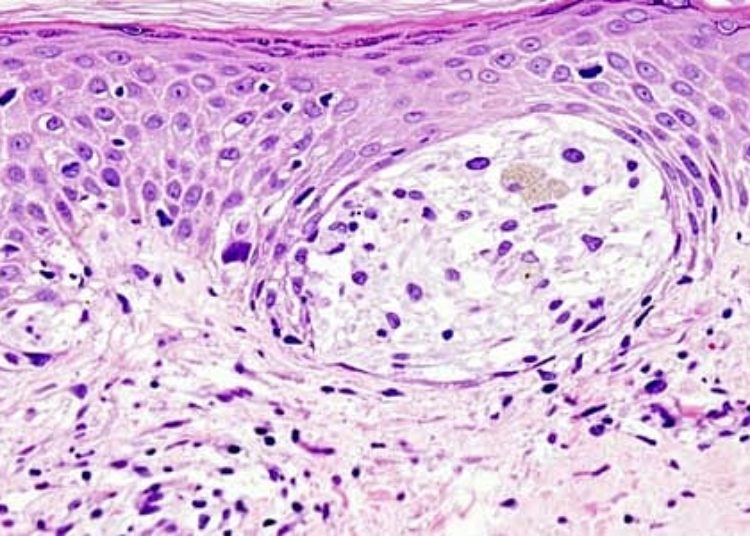 Medicare beneficiaries have a lower rate of delayed melanoma surgeries