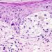 Medicare beneficiaries have a lower rate of delayed melanoma surgeries