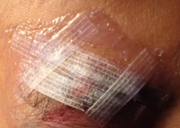 Using adhesive strips with dermal sutures does not improve cosmesis