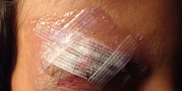 Using adhesive strips with dermal sutures does not improve