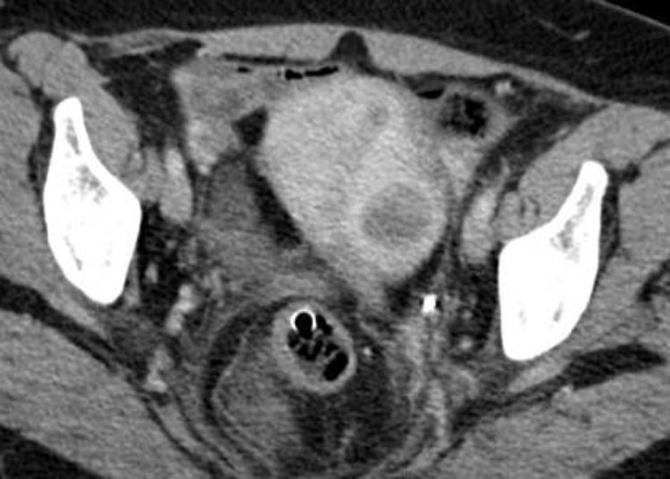 Simvastatin associated with slowed fibroid growth in mice