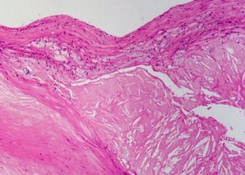 PCSK9 antibodies safe and effective in treating dyslipidemia