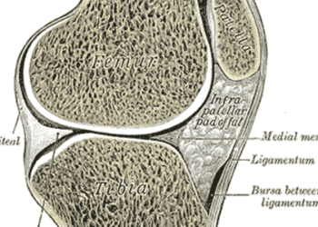 Hematopoietic stem-cell transplantation may increase risk of fractures