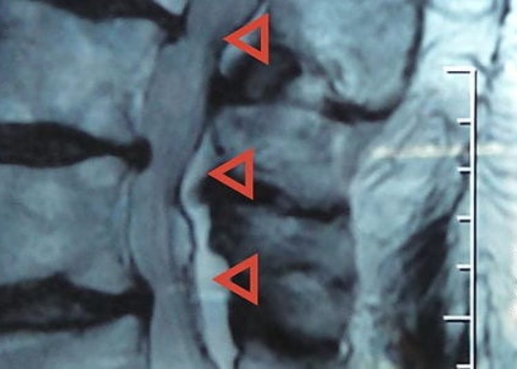 Similar outcomes between physical therapy and surgery for lumbar spinal stenosis