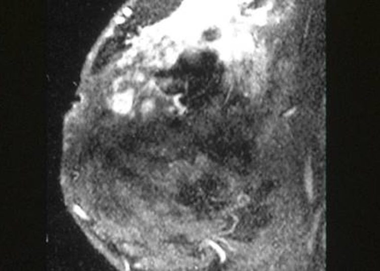 Preoperative bilateral breast imaging may reduce contralateral cancer recurrence