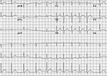 Lariat device for left atrial appendage exclusion associated with adverse events