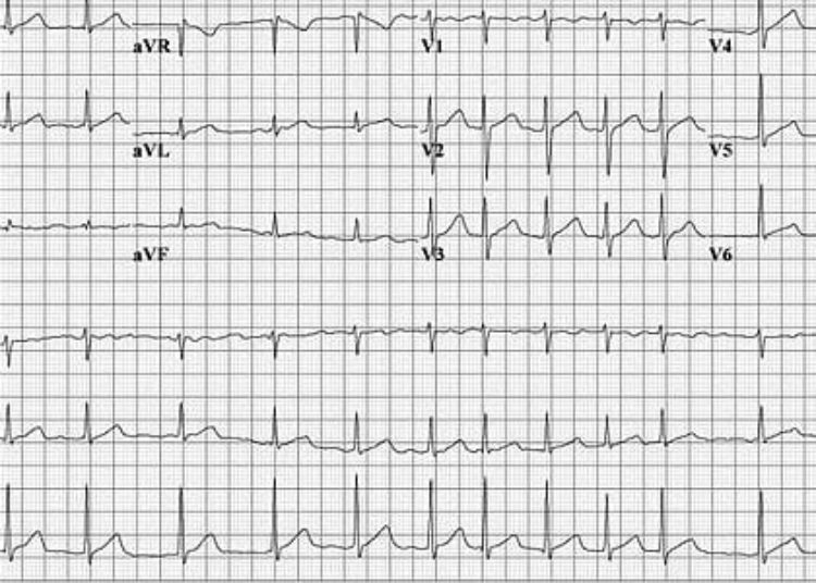 Lariat device for left atrial appendage exclusion associated with adverse events