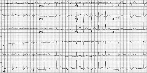 afib