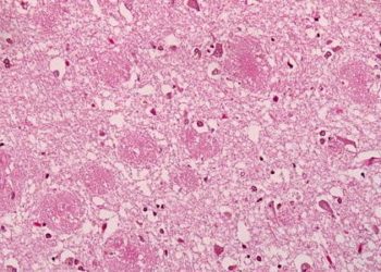 Amyloid pathology may be detected decades prior to Alzheimer’s diagnosis