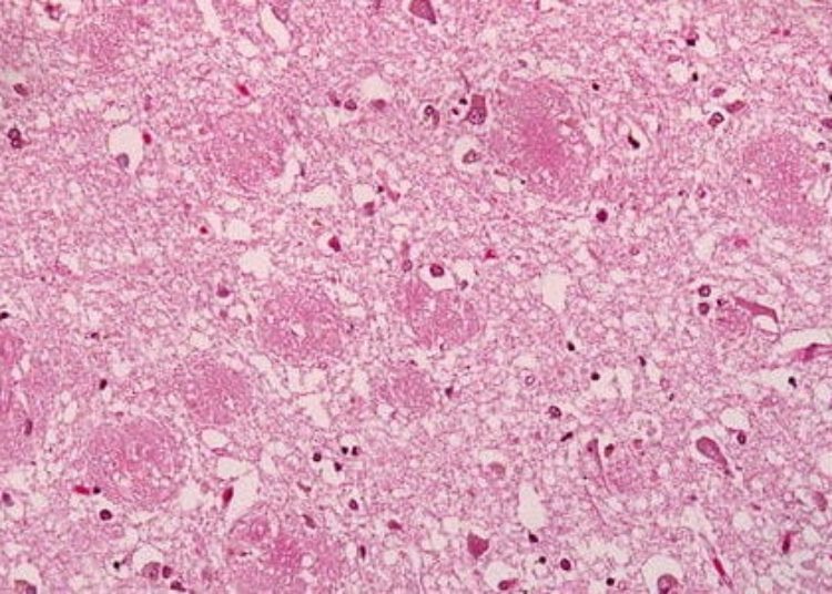 Amyloid pathology may be detected decades prior to Alzheimer’s diagnosis
