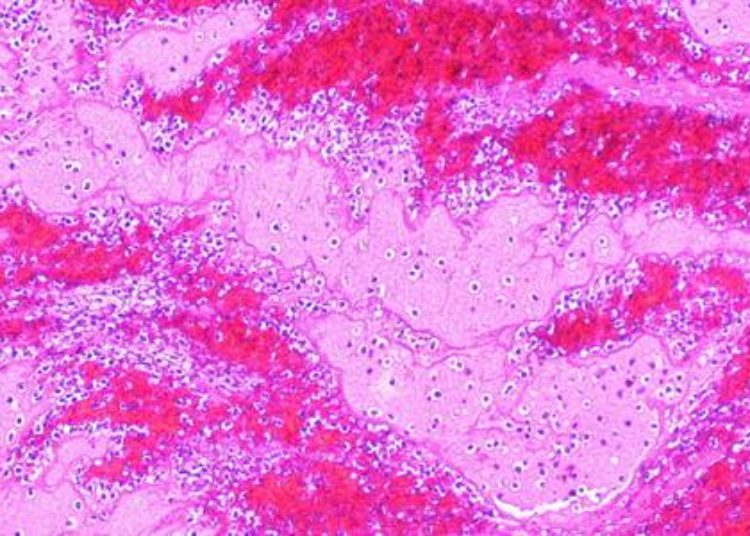 Primary thromboembolism prophylaxis may be effective in advanced cancer