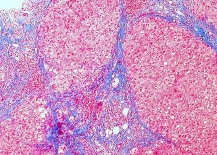 Novel combination therapy may be effective for noncirrhotic HCV infection [UNITY-1 trial]