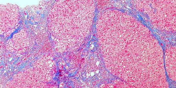 cirrhosis2