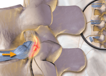 Oral prednisone improves function, not pain in acute lumbar radiculopathy