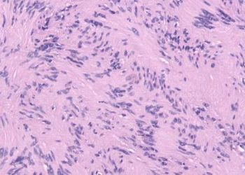 Stereotactic radiosurgery may effectively treat facial nerve schwannoma