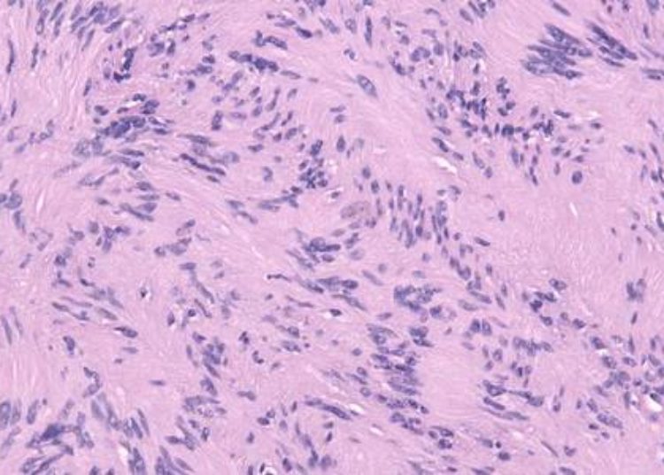Stereotactic radiosurgery may effectively treat facial nerve schwannoma