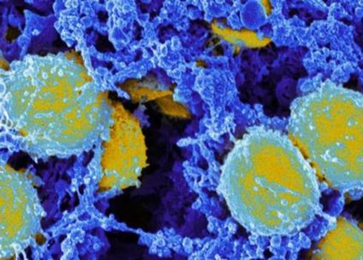 FDG-PET may guide antibiotic therapy in vascular graft infections