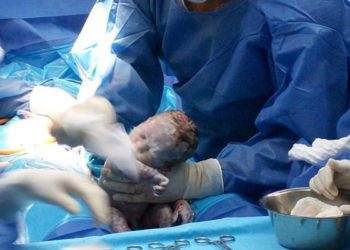 Amniotic fluid lactate associated with labor disorders