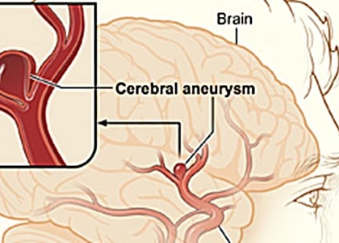 Patient Basics: Intracranial Aneurysms | 2 Minute Medicine