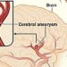 Endovascular treatment of intracranial aneurysms prevents long-term recurrence