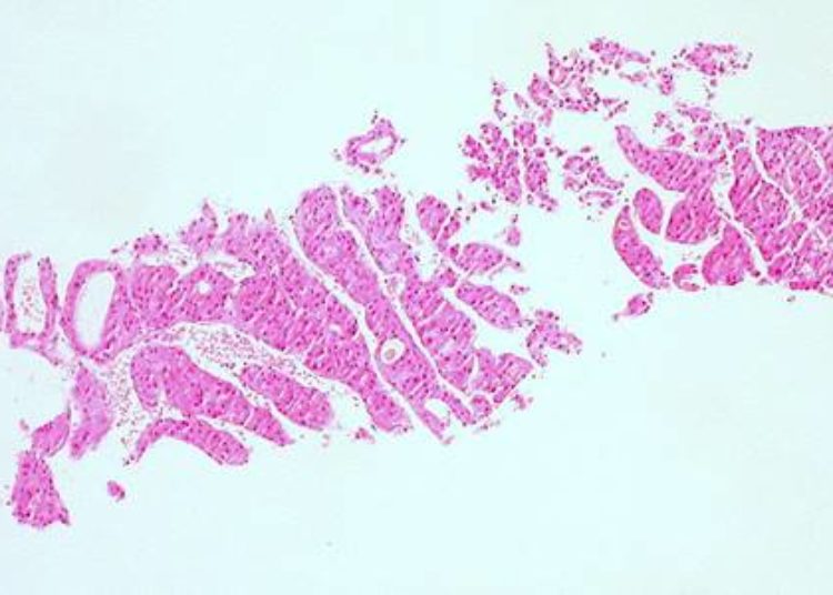 Prognostic nomograms predict survival after chemoembolization of hepatocellular carcinoma