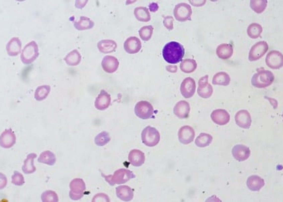 Data supports limiting blood transfusions for moderate anemia | 2 ...