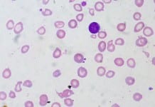 Intravenous iron associated with increased infection risk compared to oral or no iron