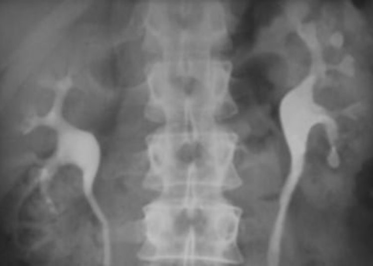 Pediatric vesicoureteral reflux, bowel/bladder dysfunction increase recurrent UTI risk