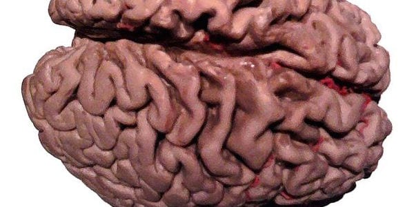 alzheimer-gross