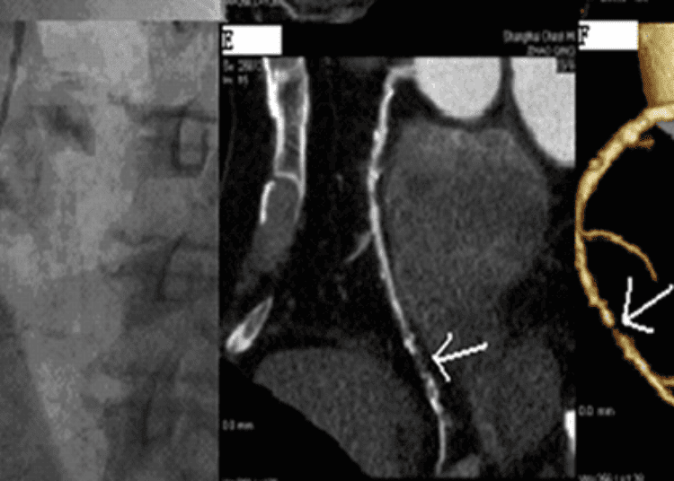 Assessment of chest pain with CT angiography as effective as radionuclide imaging