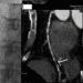 Assessment of chest pain with CT angiography as effective as radionuclide imaging