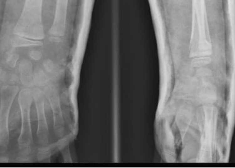 Rate of occult fracture evaluations for child abuse insufficient