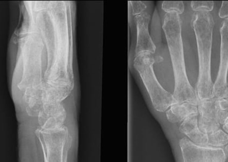 Transplantation of genetically altered stem cells improves bone formation in mice [PreClinical]
