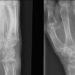 Transplantation of genetically altered stem cells improves bone formation in mice [PreClinical]
