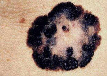 Combination trametinib and dabrafenib show fewer side effects for metastatic melanoma than dabrafenib alone