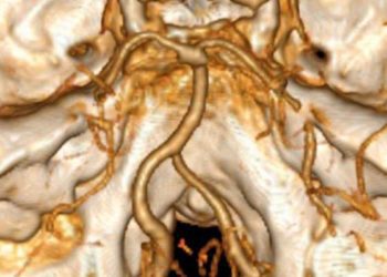 CT perfusion-derived angiography aids in detecting arterial occlusion in stroke