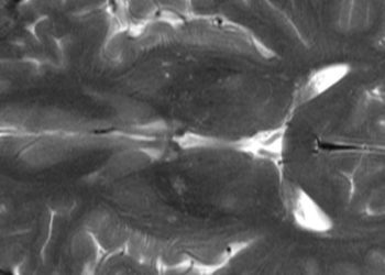 Brain lesions on MRI linked with subsequent increased stroke risk