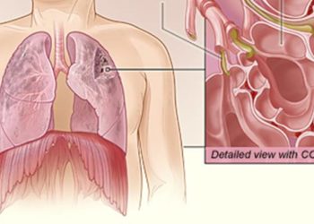 CT and MR imaging measurements reflect symptoms of progressive lung disease