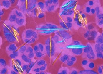 Allopurinol for asymptomatic hyperuricemia associated with hypersensitivity reactions