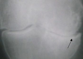 Placebo formulation impacts effectiveness of pain control in osteoarthritis