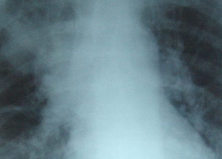 Prescription of antibiotics for acute respiratory infections increasing