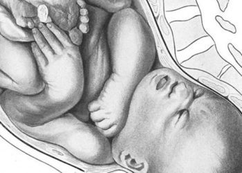 Undiagnosed hypothyroidism associated with adverse pregnancy outcomes