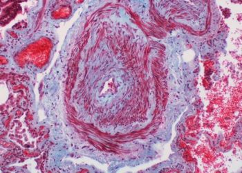 Pediatric pulmonary hypertension, a growing healthcare burden