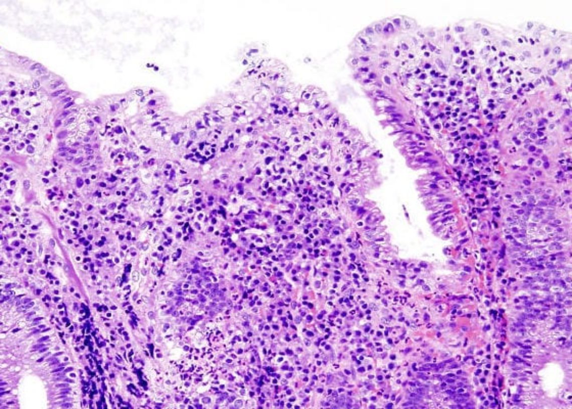 Tofacitinib effective as induction and maintenance therapy for