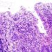 Elective colectomy associated with improved survival in ulcerative colitis